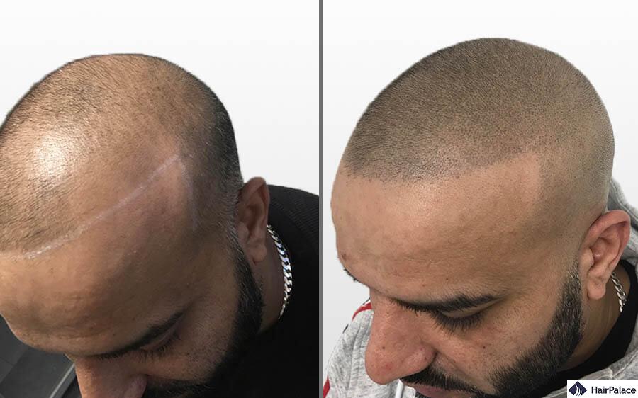 The Benefits of Scalp Micropigmentation for Hair Loss